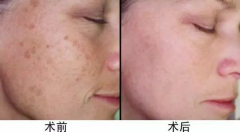 超皮秒價(jià)格，超皮秒廠(chǎng)家哪個(gè)比較好？